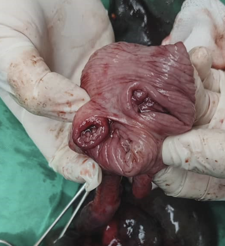 Ilial duplication ,is a rare condition predisposing to bowel ischemia